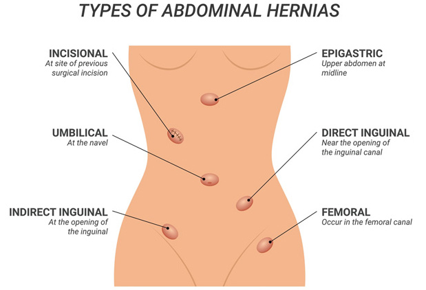 HerniaBodyImages